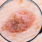 Dezembro Laranja: mês de prevenção ao câncer de pele